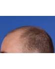Before Hair Transplant&nbsp;Front